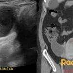 Ultrasound and CT images showing an appendiceal mucocele in the right adnexa.