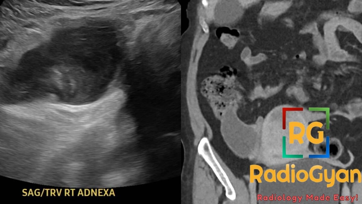Ultrasound and CT images showing an appendiceal mucocele in the right adnexa.