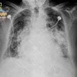 Chest X-ray showing bilateral perihilar airspace opacities consistent with a batwing distribution, indicative of pulmonary edema.