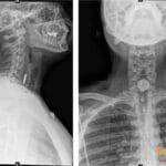 Lateral and AP X-ray views showing a button battery lodged in the upper esophagus.