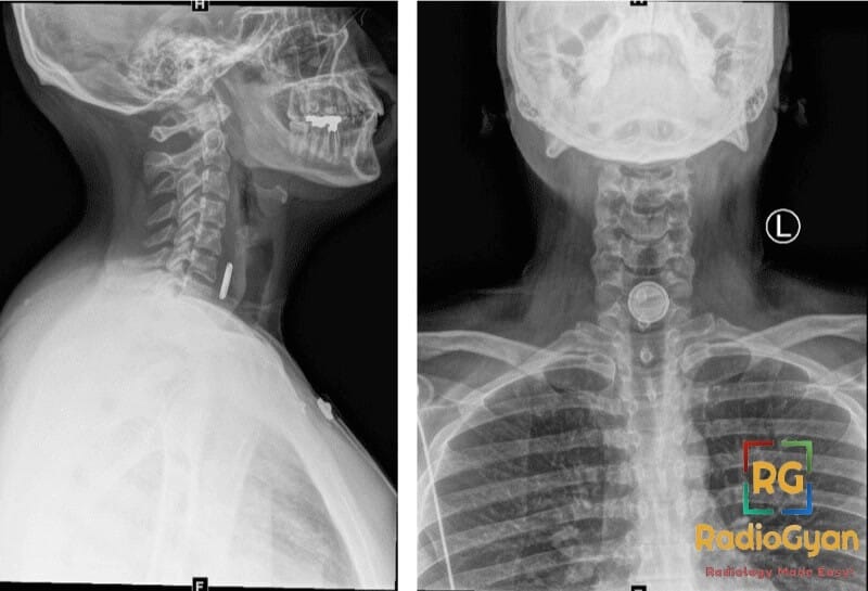 Lateral and AP X-ray views showing a button battery lodged in the upper esophagus.