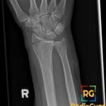 X-ray of a right wrist showing a Chauffeur's fracture, an intraarticular fracture of the distal radius.