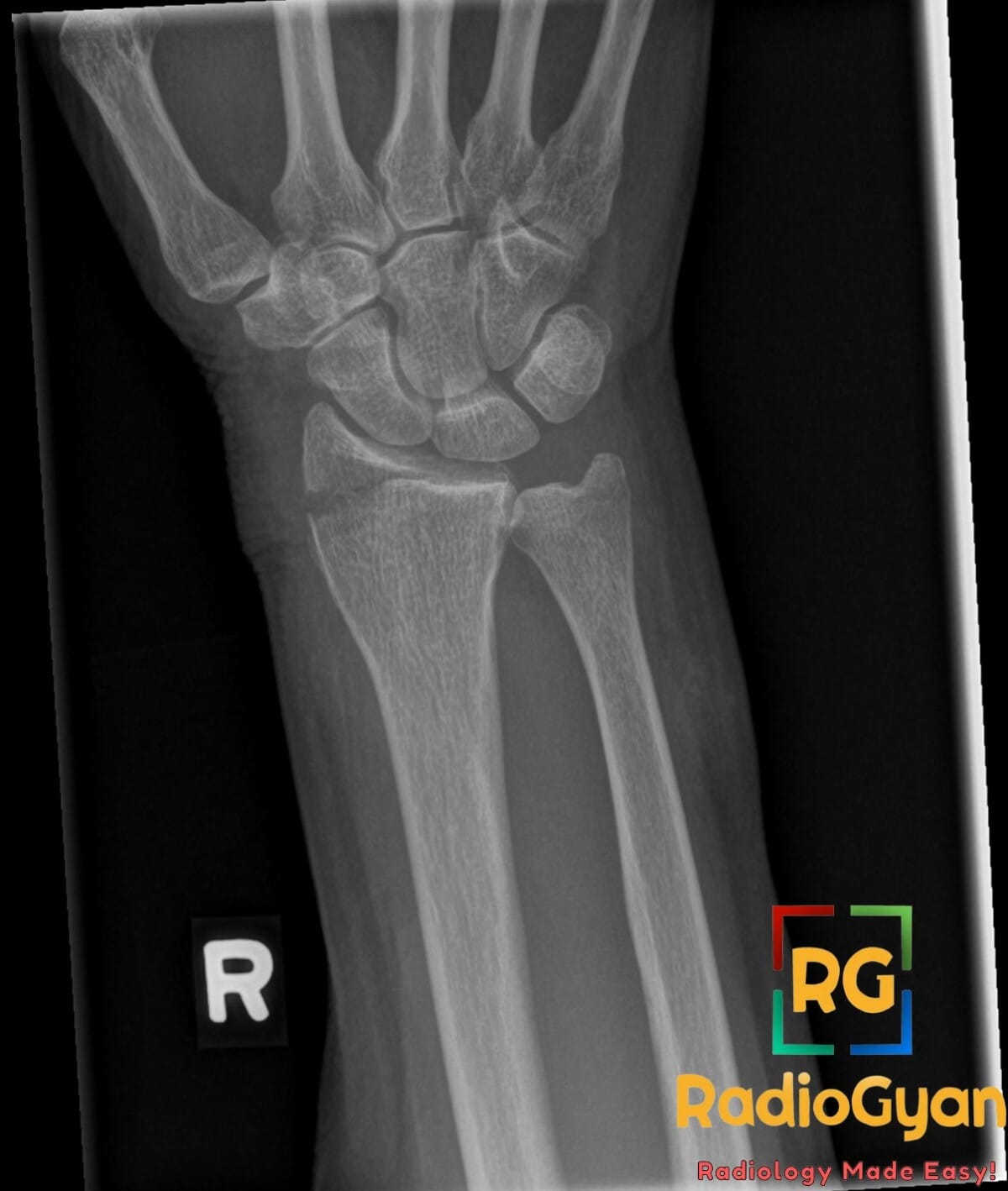 X-ray of a right wrist showing a Chauffeur's fracture, an intraarticular fracture of the distal radius.