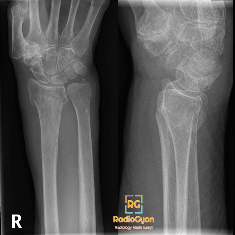X-ray of right wrist showing a Colles fracture with dorsal displacement of the distal radius fragment.