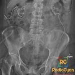 Abdominal X-ray showing bilateral nephrostomy catheters and pneumaturia indicative of emphysematous cystitis.