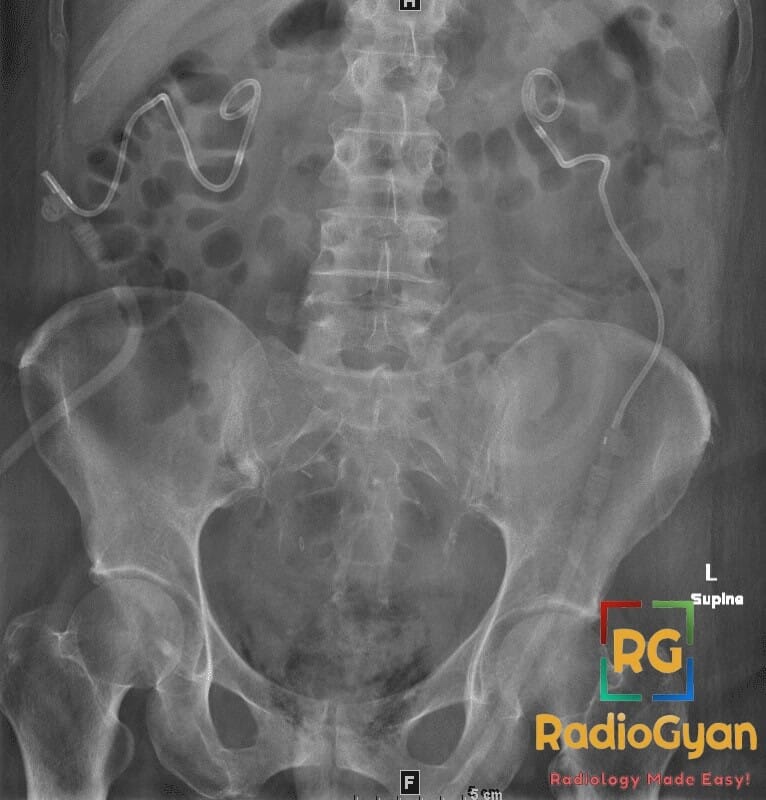 Abdominal X-ray showing bilateral nephrostomy catheters and pneumaturia indicative of emphysematous cystitis.