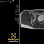 Ultrasound and MRI images revealing a large endometrioma in the pelvic region, showing characteristic 'ground glass' appearance.
