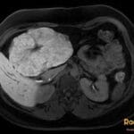 Primovist MRI showing a large Focal Nodular Hyperplasia (FNH) in the liver, demonstrating contrast enhancement.
