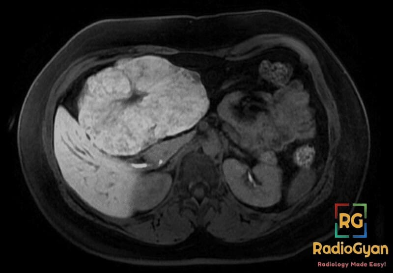 Primovist MRI showing a large Focal Nodular Hyperplasia (FNH) in the liver, demonstrating contrast enhancement.