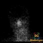 Nuclear medicine scan showing increased tracer uptake in nasal and paranasal regions, consistent with 'hot nose' sign.