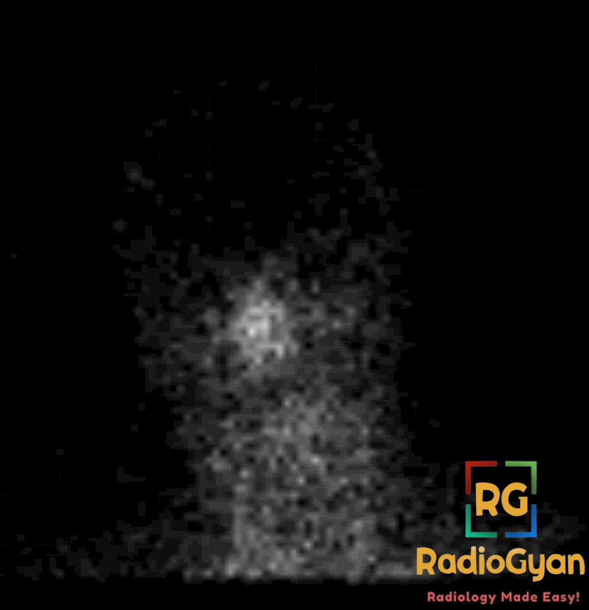 Nuclear medicine scan showing increased tracer uptake in nasal and paranasal regions, consistent with 'hot nose' sign.