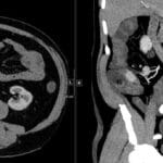 CT abdomen: Hypervascular lesion in terminal ileum, axial and coronal views. Suggestive of carcinoid tumor.