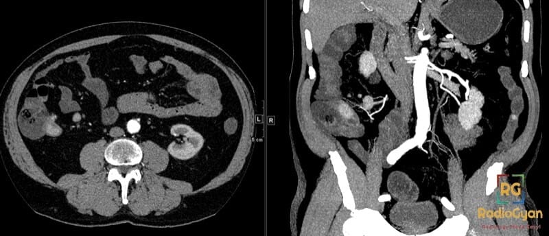 CT abdomen: Hypervascular lesion in terminal ileum, axial and coronal views. Suggestive of carcinoid tumor.