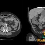 Axial and coronal CT enterography images showing jejunal angiodysplasia in the small bowel.