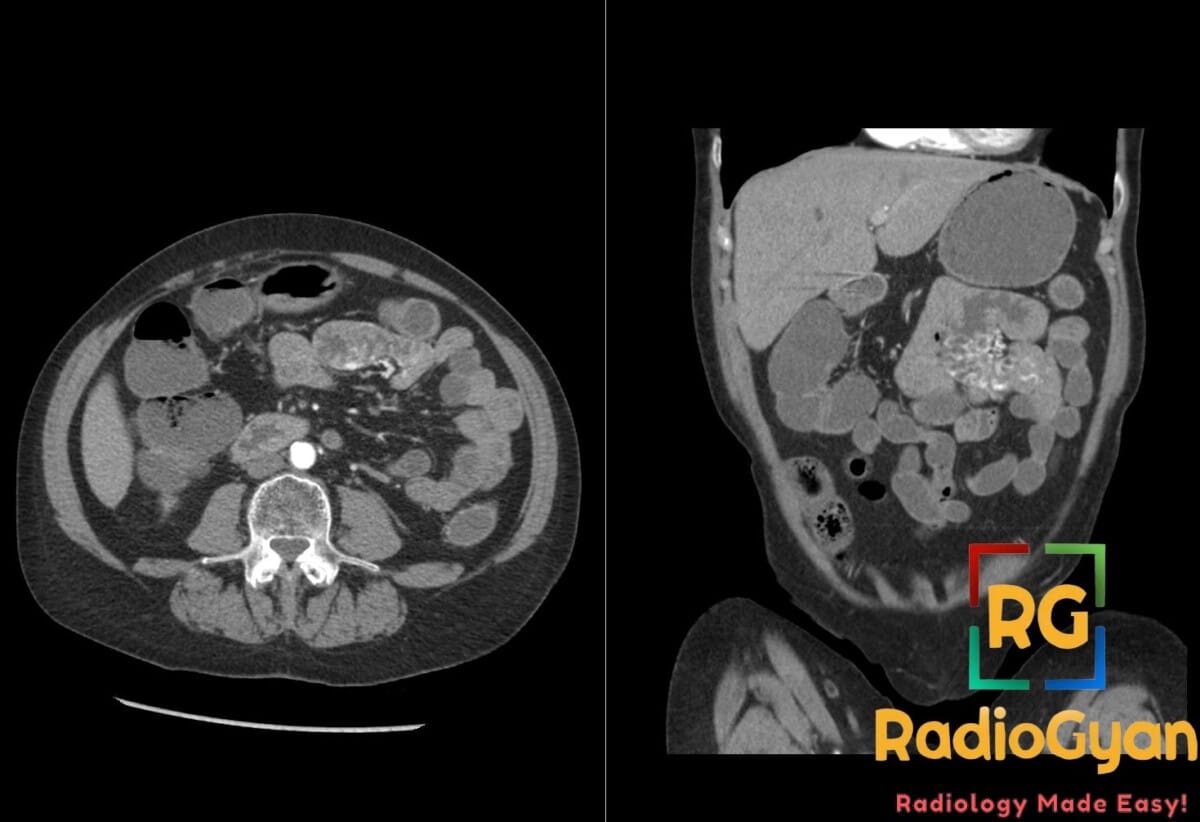 Axial and coronal CT enterography images showing jejunal angiodysplasia in the small bowel.