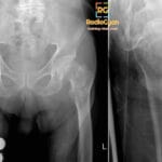 AP and lateral radiographs of the left hip and pelvis showing a left intertrochanteric femur fracture.