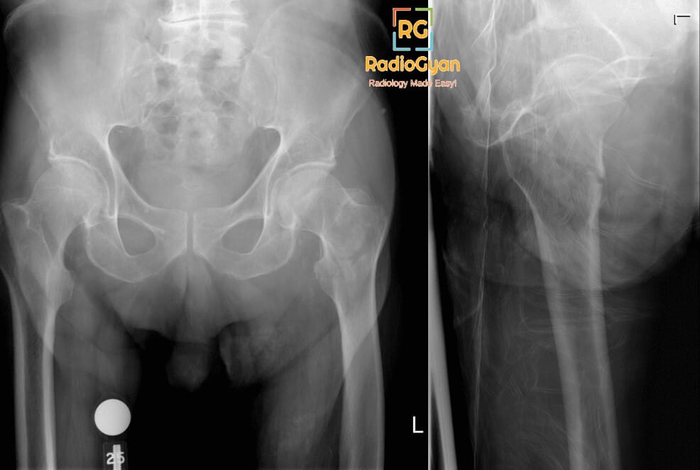 AP and lateral radiographs of the left hip and pelvis showing a left intertrochanteric femur fracture.