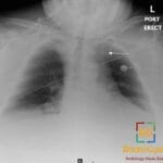 Chest X-ray showing anomalous left-sided superior vena cava (LSVC) with an arrow pointing to the vein.