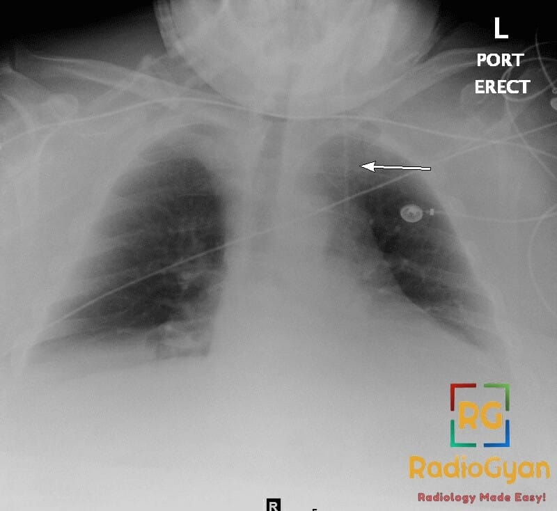 Chest X-ray showing anomalous left-sided superior vena cava (LSVC) with an arrow pointing to the vein.