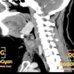Sagittal CT scan of the neck showing an abnormal mass at the base of the tongue, consistent with lingual thyroid.