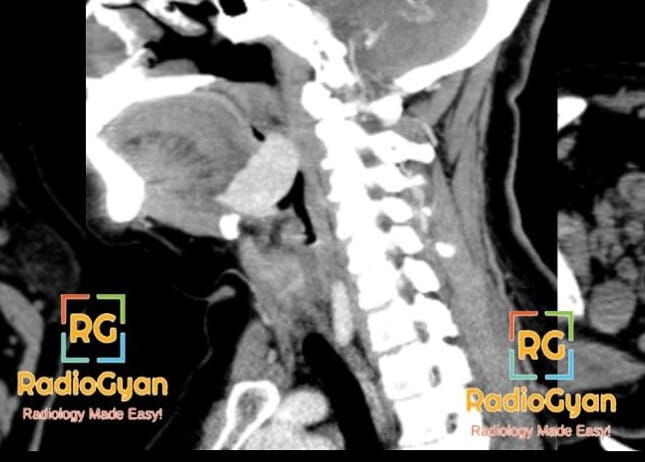 Sagittal CT scan of the neck showing an abnormal mass at the base of the tongue, consistent with lingual thyroid.