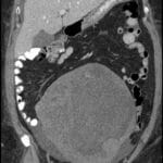 Coronal CT scan showing Meigs syndrome with ascites, right ovarian mass, and pleural effusion.