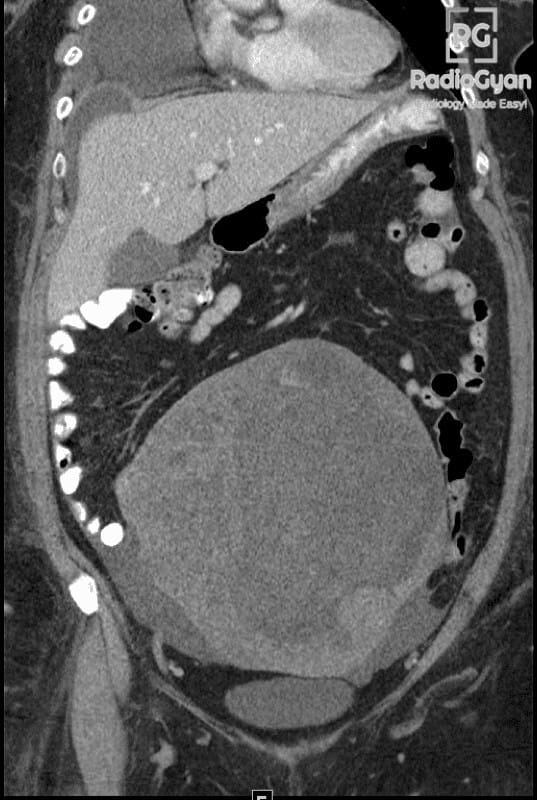 Coronal CT scan showing Meigs syndrome with ascites, right ovarian mass, and pleural effusion.