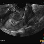 Ultrasound image showing an IUCD misplaced in the sagittal view of the cervix.