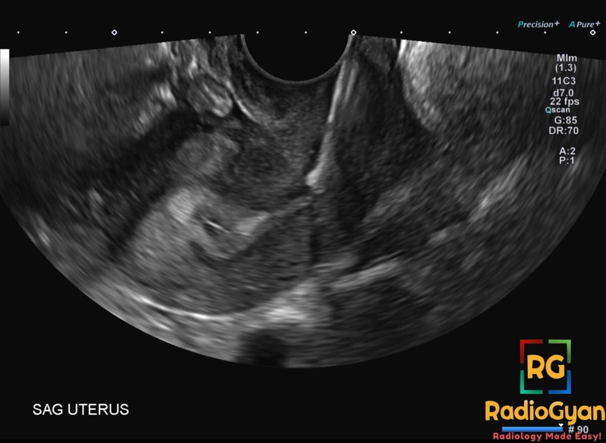 Ultrasound image showing an IUCD misplaced in the sagittal view of the cervix.
