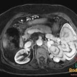 Axial MRI image showing the Moire Spleen characterized by a complex splenic vascular anatomy.