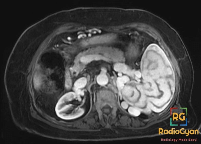 Axial MRI image showing the Moire Spleen characterized by a complex splenic vascular anatomy.