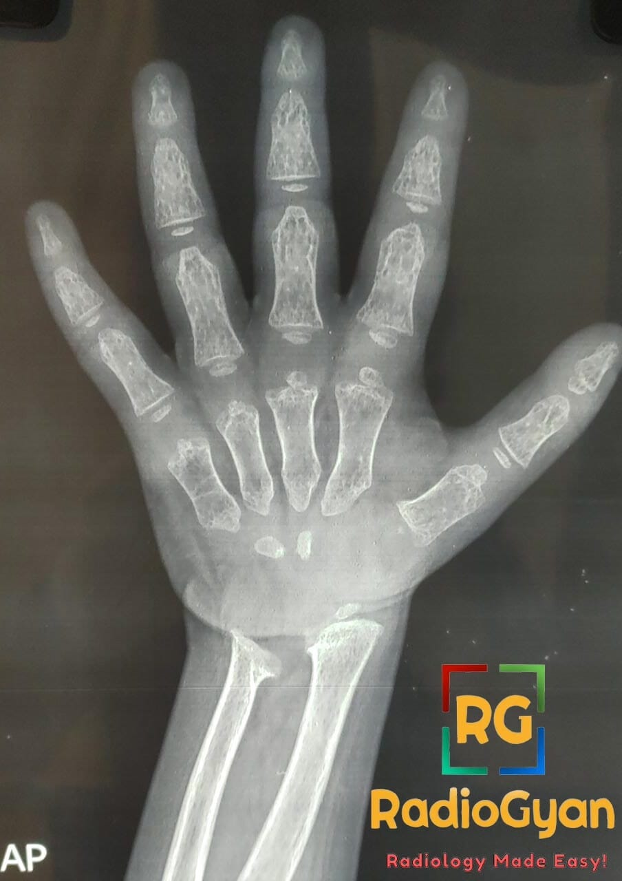 AP X-ray of a pediatric hand and wrist showing dysostosis multiplex suggestive of mucopolysaccharidosis.