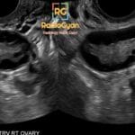 Transvaginal ultrasound of right ovary displaying numerous peripheral follicles characteristic of polycystic ovaries.