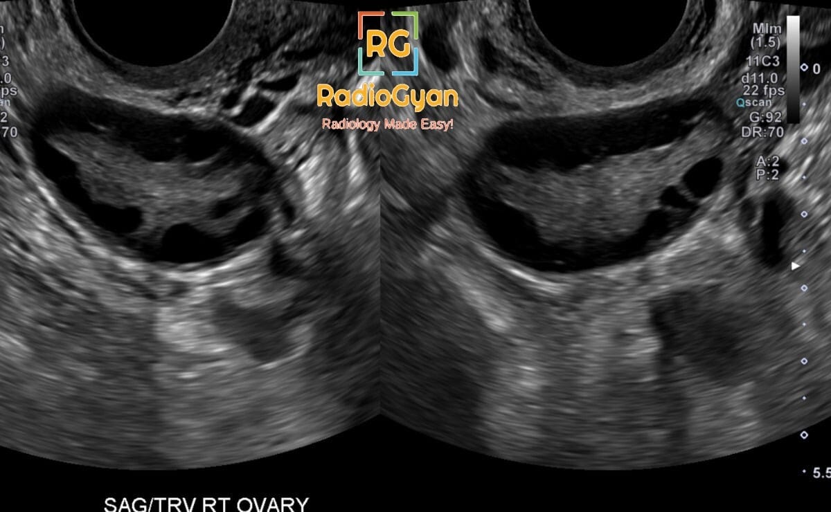 Transvaginal ultrasound of right ovary displaying numerous peripheral follicles characteristic of polycystic ovaries.