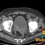 CT abdomen/pelvis axial view showing a Prolene mesh causing a right inguinal hernia with fat content, indicated by an arrow.