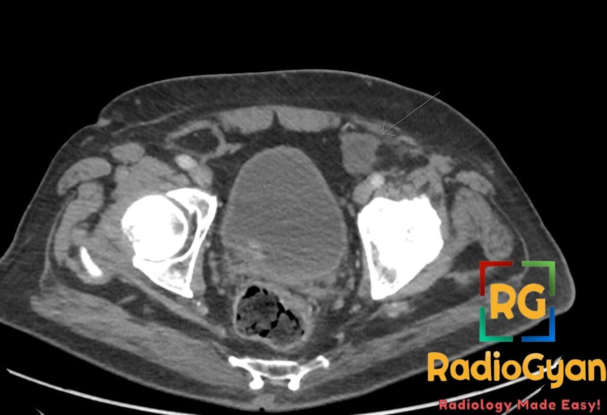 CT abdomen/pelvis axial view showing a Prolene mesh causing a right inguinal hernia with fat content, indicated by an arrow.