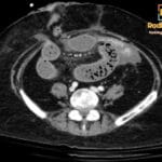 Axial CT image showing small bowel loops with intraluminal fecal material, characteristic of the small bowel feces sign.
