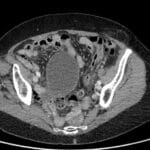 Axial CT image of the abdomen and pelvis identifying a Spigelian hernia, a rare type of ventral hernia.
