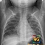 Chest X-ray showing steeple sign, indicative of croup in a pediatric patient.