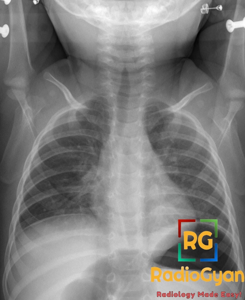 Chest X-ray showing steeple sign, indicative of croup in a pediatric patient.