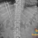 Abdominal X-ray showing thumb-printing pattern in the large bowel, indicating ischemic colitis.