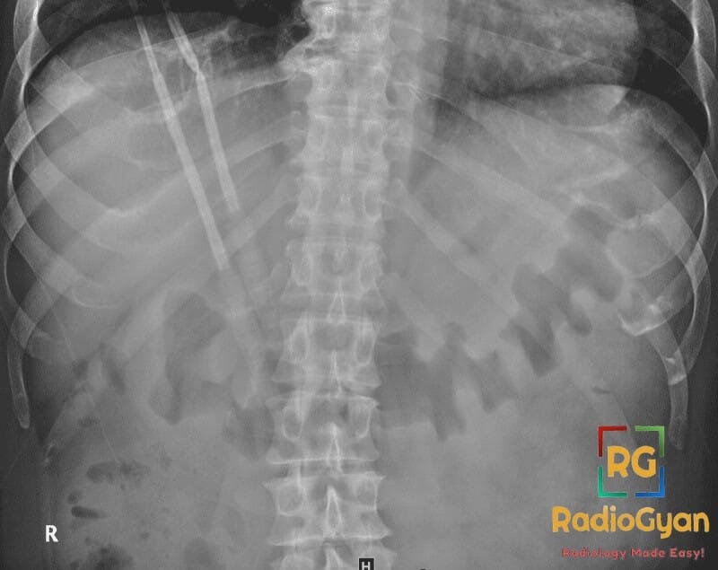 Abdominal X-ray showing thumb-printing pattern in the large bowel, indicating ischemic colitis.