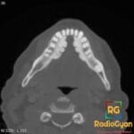 Axial CT scan showing bilateral mandibular tori along the lingual aspect of the mandible.