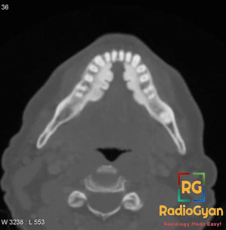 Axial CT scan showing bilateral mandibular tori along the lingual aspect of the mandible.