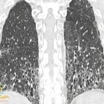 CT scan of lungs showing Usual Interstitial Pneumonia (UIP) pattern with honeycombing and traction bronchiectasis.