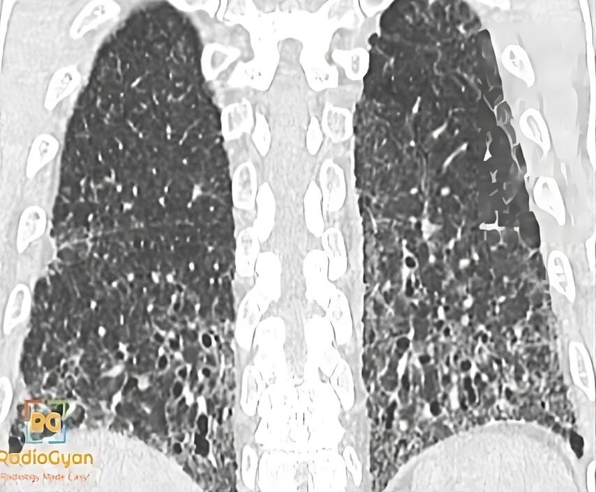 CT scan of lungs showing Usual Interstitial Pneumonia (UIP) pattern with honeycombing and traction bronchiectasis.