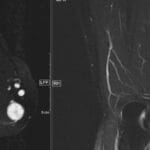 MRI image showing an ulnar nerve schwannoma in axial and coronal views.