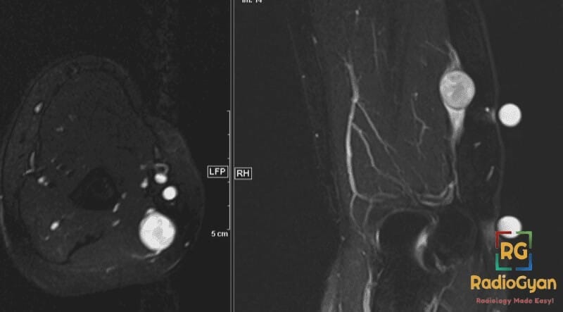 MRI image showing an ulnar nerve schwannoma in axial and coronal views.