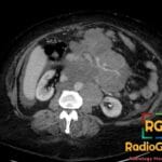 CT axial view showing mesenteric lymphoma with extensive retroperitoneal lymphadenopathy, forming a 'Hamburger sign'.