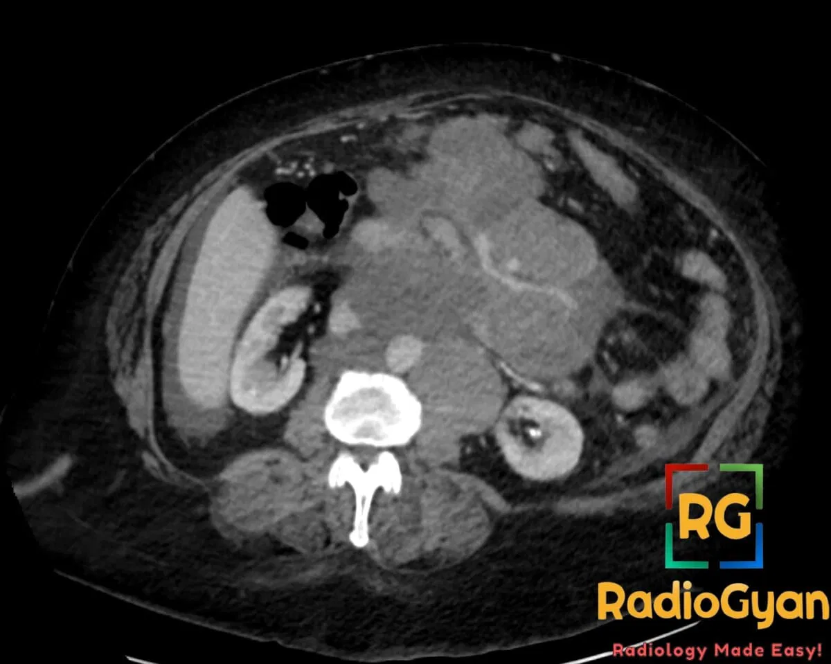 CT axial view showing mesenteric lymphoma with extensive retroperitoneal lymphadenopathy, forming a 'Hamburger sign'.